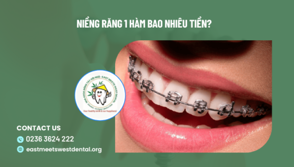 Niềng Răng 1 Hàm bao nhiêu tiền?