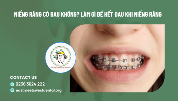 Niềng Răng Có Đau Không? Làm Gì Để Hết Đau Khi Niềng Răng