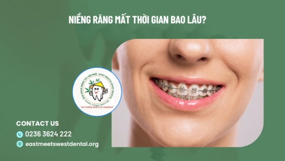Niềng răng mất thời gian bao lâu?