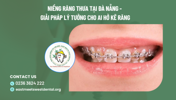 Niềng răng thưa tại Đà Nẵng – giải pháp lý tưởng cho ai hở kẽ răng