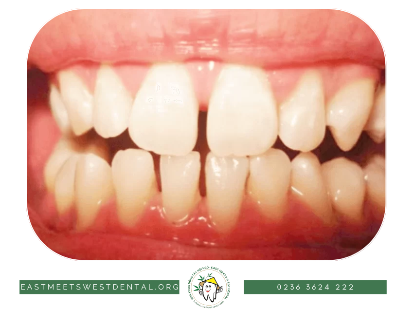 Răng thưa là tình trạng các răng mọc cách xa nhau hoặc bị thiếu răng