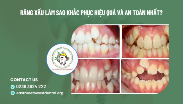 Răng xấu làm sao khắc phục hiệu quả và an toàn nhất?