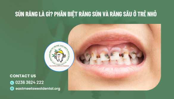 Sún răng là gì? Phân biệt răng sún và răng sâu ở trẻ nhỏ