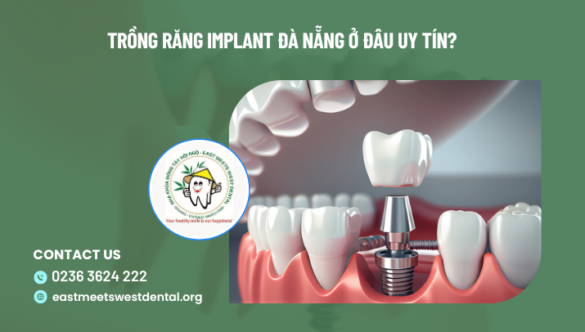 Địa chỉ nha khoa trồng răng implant Đà Nẵng uy tín