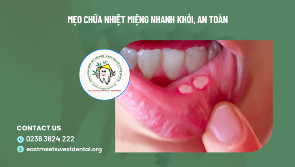 Mẹo chữa nhiệt miệng nhanh khỏi, an toàn