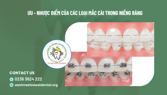 Ưu – nhược điểm của các loại mắc cài trong niềng răng
