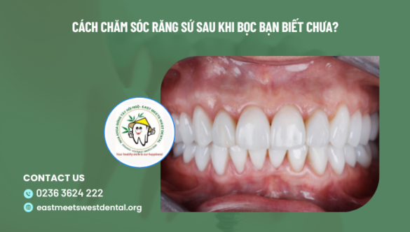 Cách chăm sóc răng sứ sau khi bọc bạn biết chưa?