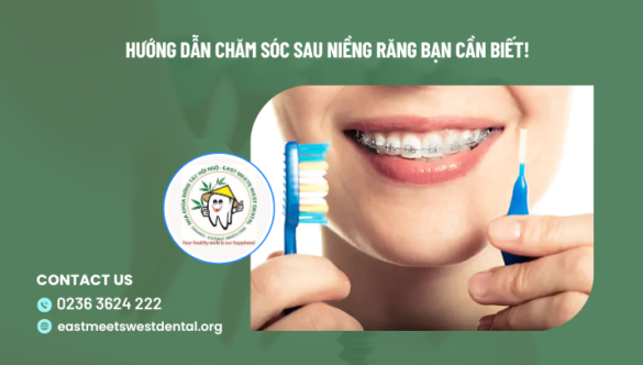 Hướng dẫn chăm sóc sau niềng răng bạn cần biết!