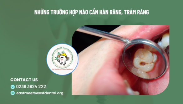 Những trường hợp nào cần hàn răng, trám răng