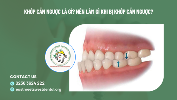 Khớp cắn ngược là gì? Nên làm gì khi bị khớp cắn ngược?
