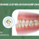 Khớp cắn ngược là gì? Nên làm gì khi bị khớp cắn ngược?