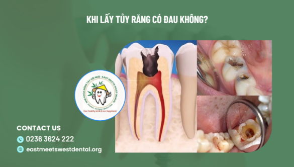 Khi lấy tủy răng có đau không?