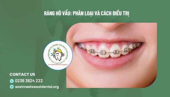 Ưu và nhược điểm của niềng răng trong suốt