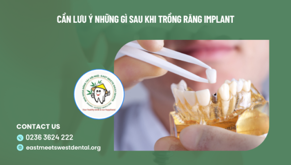 Cần lưu ý những gì sau khi trồng răng implant
