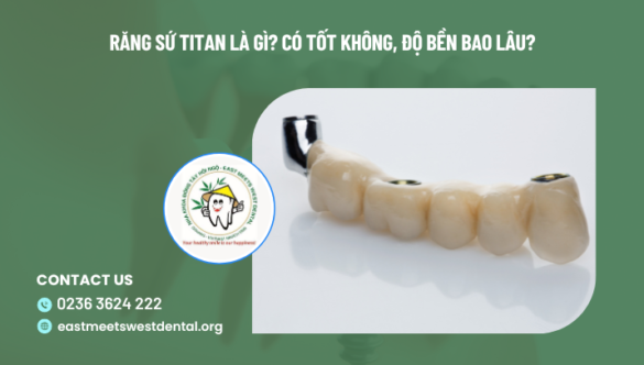 Răng sứ Titan là gì? Có tốt không, độ bền bao lâu?