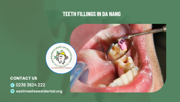 Teeth fillings in Da Nang