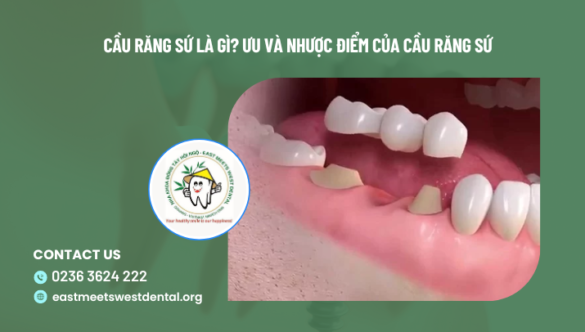 Cầu Răng Sứ Là Gì? Ưu Và Nhược Điểm Của Cầu Răng Sứ