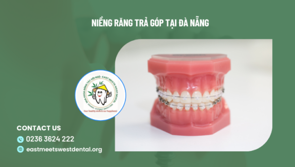 Niềng Răng Trả Góp Tại Đà Nẵng