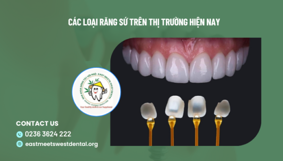 Các loại răng sứ trên thị trường hiện nay