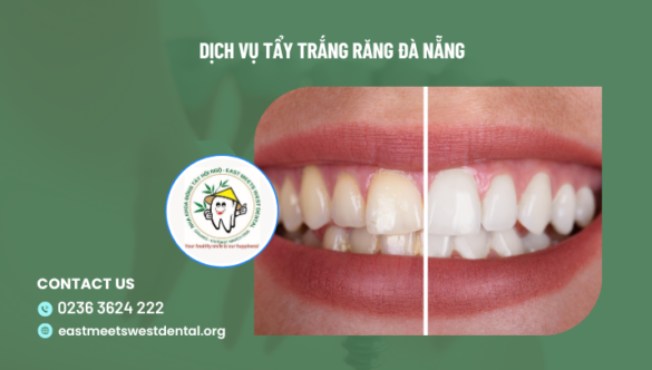 Dịch vụ tẩy trắng răng Đà Nẵng